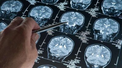 Tuğçe AKKAŞ, – YENİ bir araştırma, Alzheimer hastalığının belirtiler ortaya